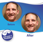 Facetas dentárias clip-on superiores e inferiores em silicone de grau médico