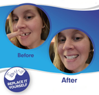 Facetas dentárias clip-on superiores e inferiores em silicone de grau médico